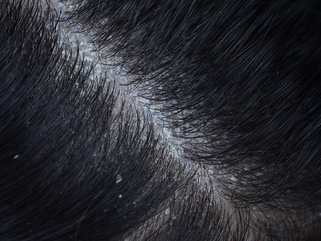 Dandruff