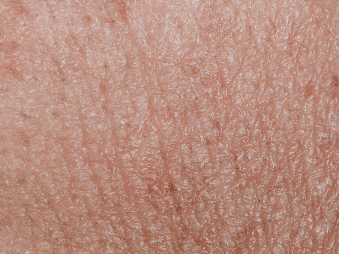 Acne Control